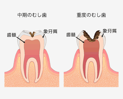 中期のむし歯と神経まで進行している重度のむし歯の解説図