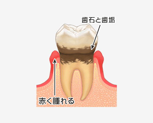 歯石と歯垢がたまって歯ぐきが炎症をおこしている歯周病の解説図