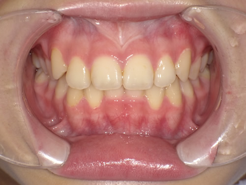 小児歯科矯正の症例写真　オーバーレイ治療