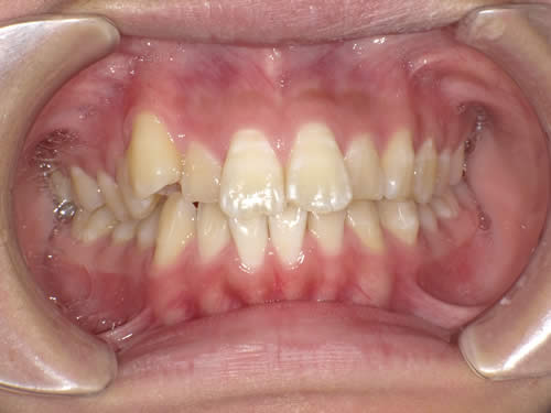 大人の矯正歯科治療の症例　ワイヤー矯正