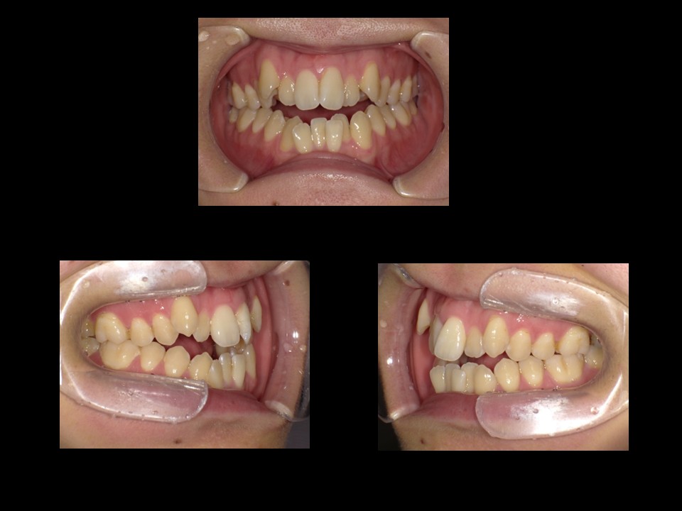 歯列矯正治療前：主訴：叢生