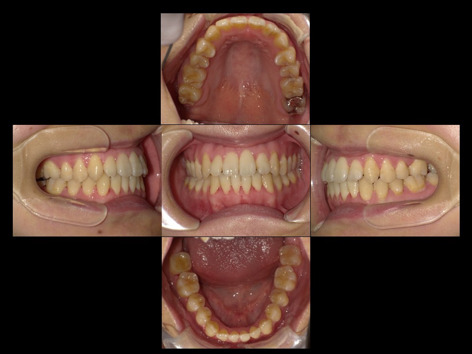 歯列矯正治療後：主訴：叢生