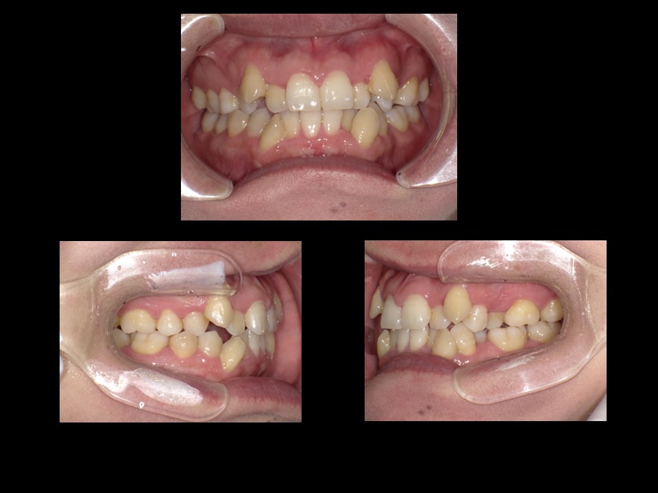 歯列矯正治療前：主訴：開口