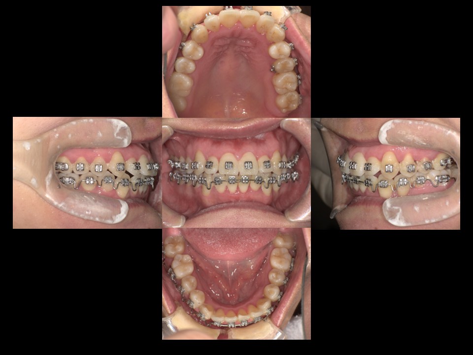 歯列矯正治療後：主訴：開口