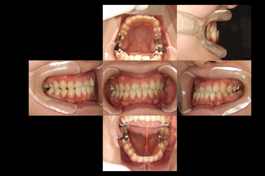 歯列矯正治療前：主訴：受け口
