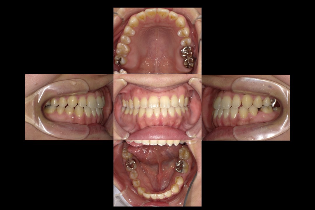 歯列矯正治療後：主訴：受け口
