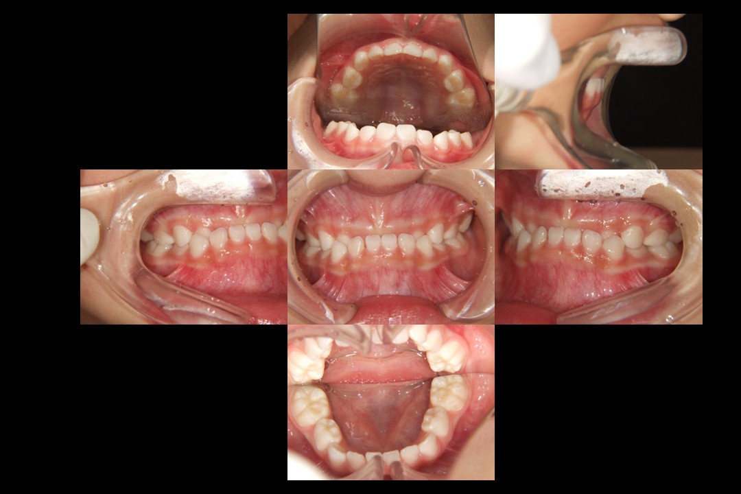 歯列矯正治療前