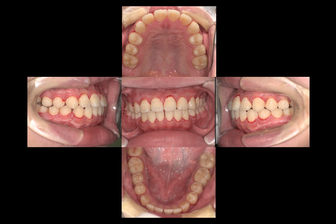 歯列矯正治療後