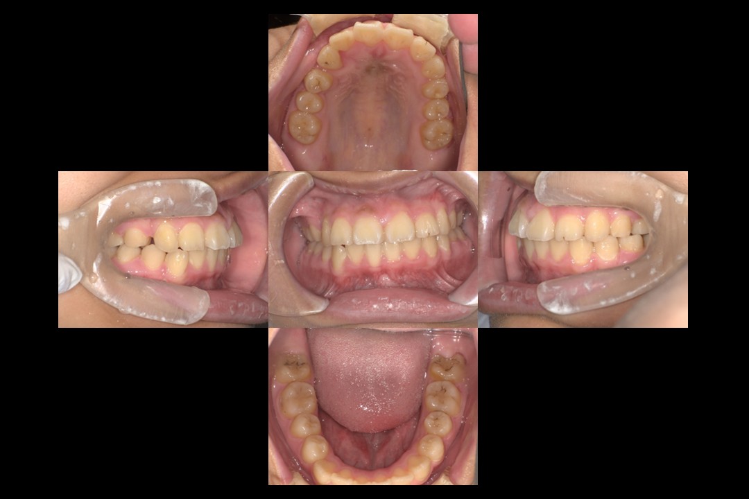 歯列矯正治療後