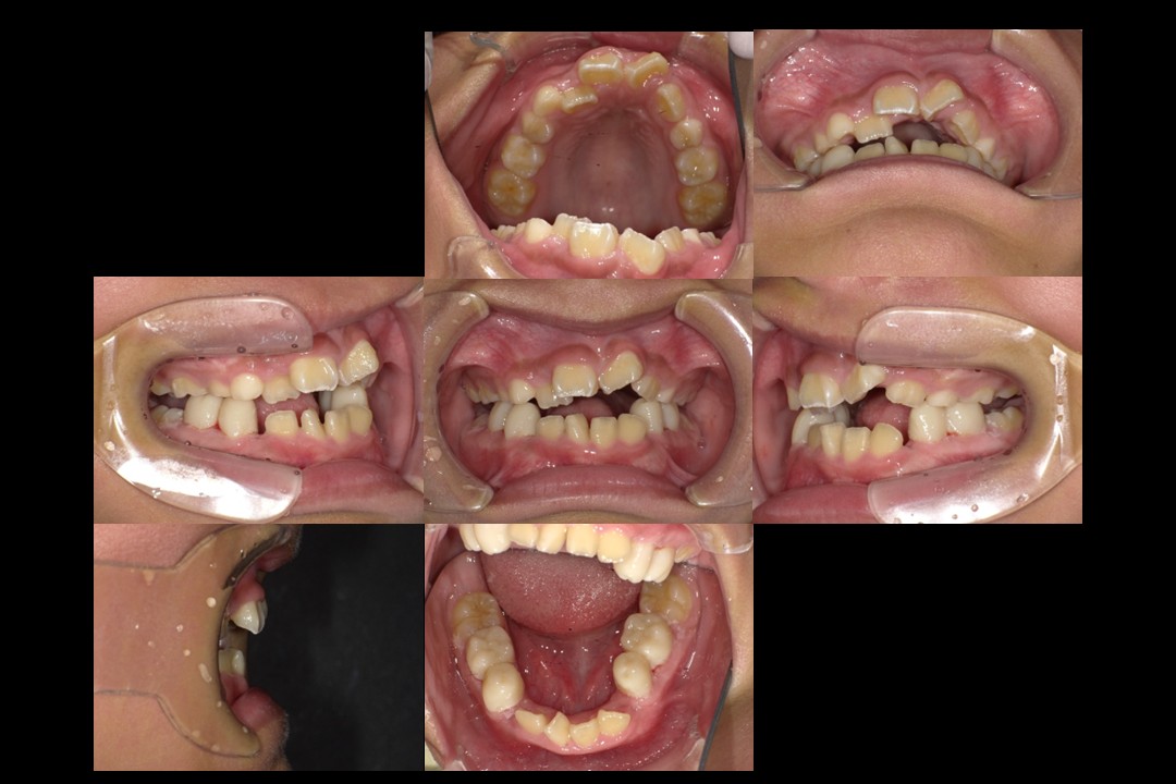 歯列矯正治療前