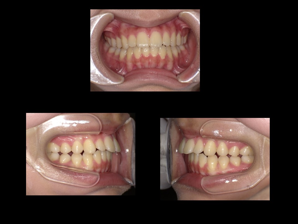 歯列矯正治療前