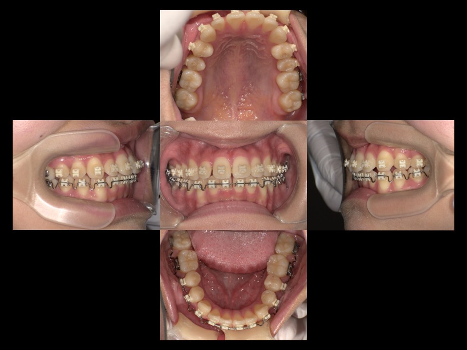 歯列矯正治療後